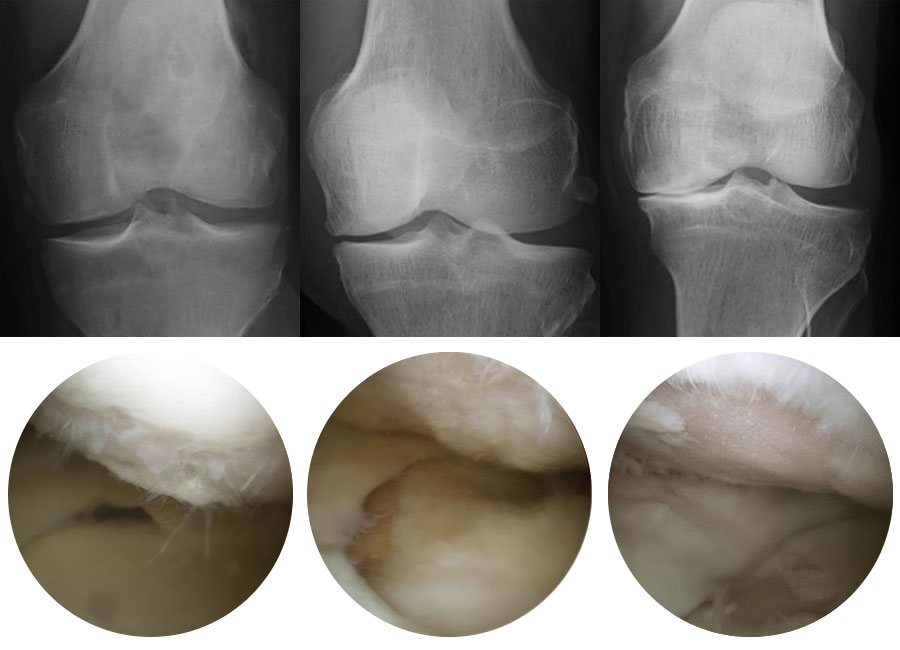 Knee Arthritis Photos and X-Rays